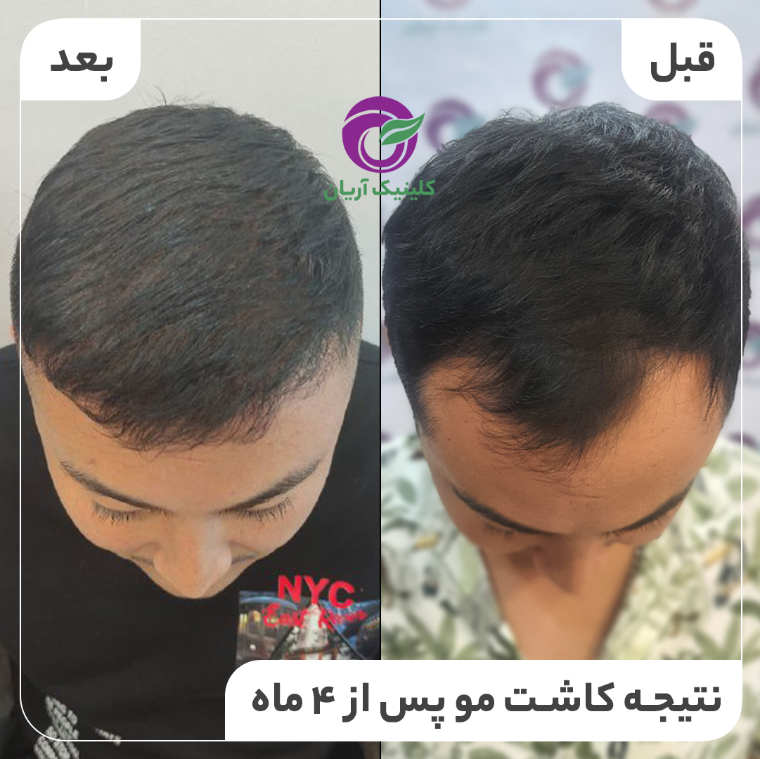 گالری کاشت مو 